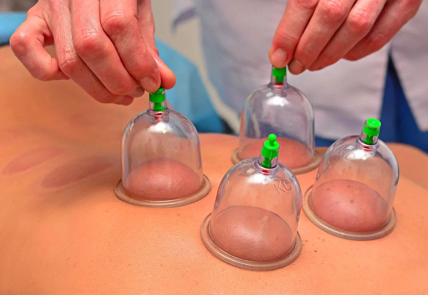 Close Up Of Physical Therapist's Hands Performing Cupping On Athelte's Back